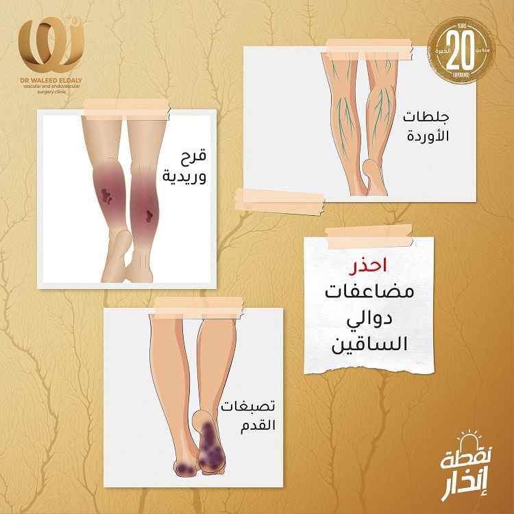 دوالي الساقين