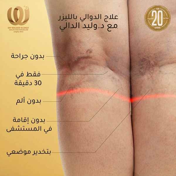 دوالي الساقين