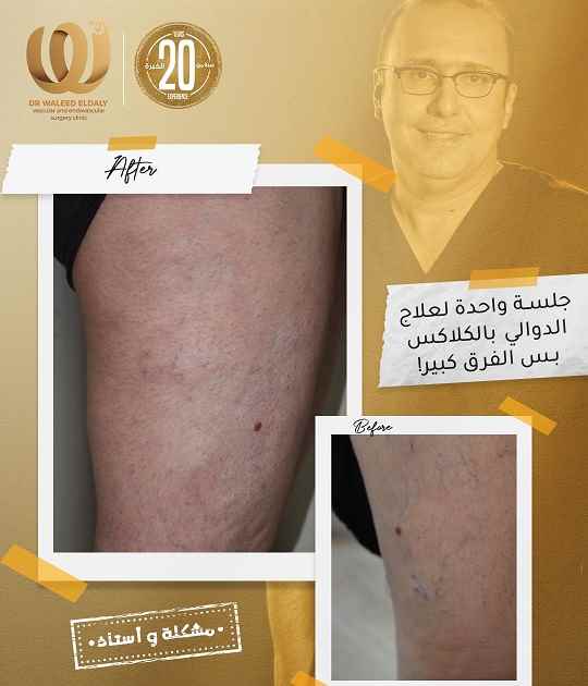 Varicose Veins of the legs