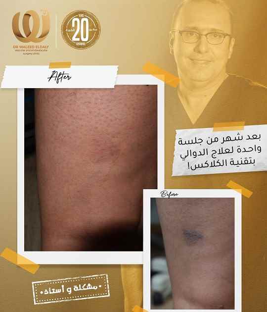 دوالي الساقين كلاكس