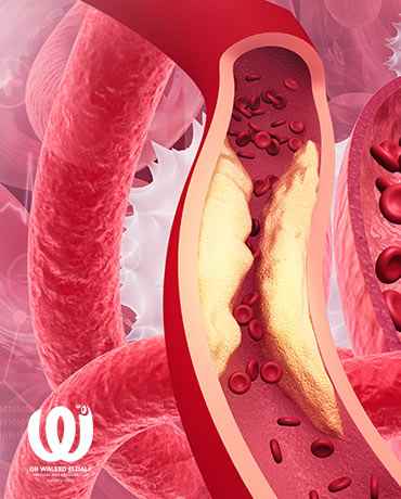  Arterial occlusion