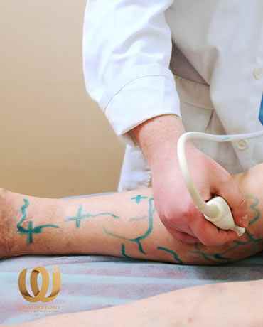 Varicose veins - legs - treatment - CLaCS - Laser - Injection