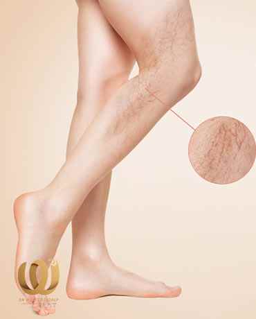 Medications - Varicose veins of legs - Treatment