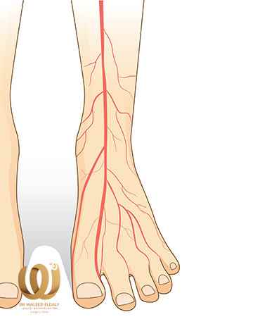 Vascular Disease in Legs Reason - Vascular Disease in legs avoidance - Vascular disease in legs symptoms