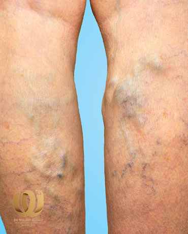 Varicose veins treatment