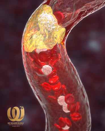 Peripheral arterial occlusion