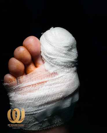 Gangrene Foot Prevention