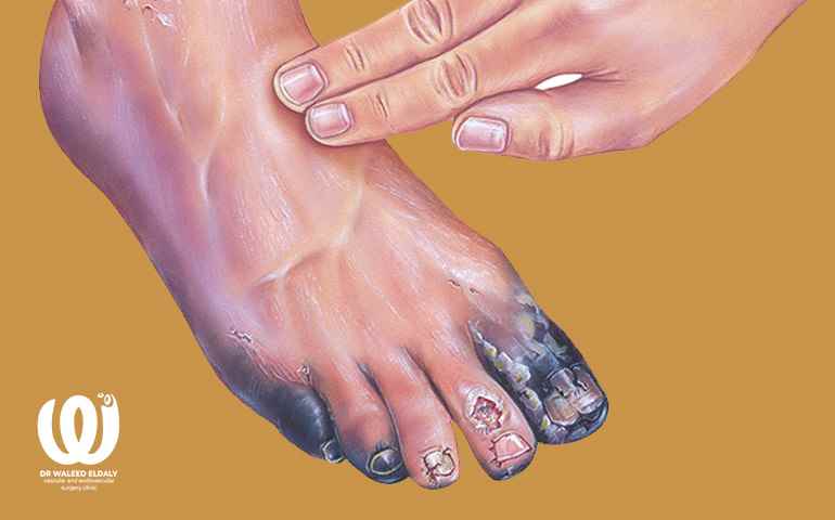 Treatment of diabetic foot gangrene