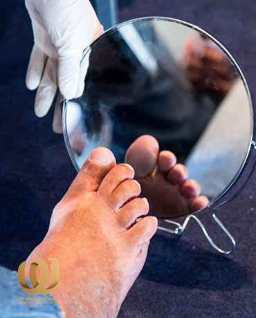 Diabetic Foot - Symptoms - Complications - Medical Dressing Types